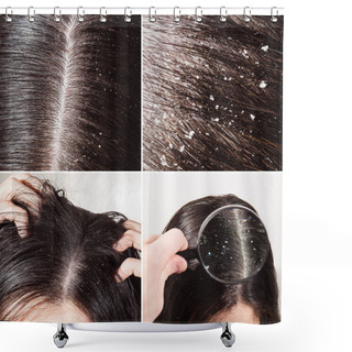 Personality  Dandruff On Her Dark Hair Shower Curtains