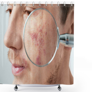 Personality  Looking At Young Man's Birthmarks Through Magnifier, Closeup Shower Curtains