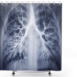 Personality  Bronchoscopy Image. Chest X-ray. Healthy Lungs Shower Curtains