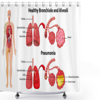 Personality  Healthy And Unhealthy Of Human Lungs Illustration Shower Curtains