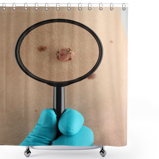 Personality  Birthmark. Dermatologist Examines Mole Close Up Shower Curtains