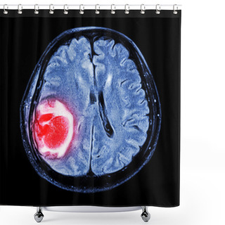 Personality  MRI Brain : Show Brain Tumor At Right Parietal Lobe Of Cerebrum Shower Curtains