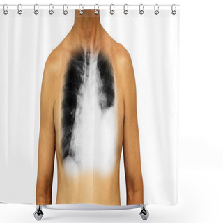 Personality  Lung Cancer . Human Chest And X-ray Show Pleural Effusion Left Lung Due To Lung Cancer Shower Curtains