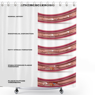 Personality  Atherosclerosis. Detailed Illustration Of Atherosclerosis Stages Shower Curtains