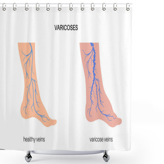 Personality  Edema And Varicose Veins. Swelling And Pain In Human Legs. Vascular Disease Diagnostic And Treatment. Abnormal Blood Pressure, Weak Vein And Valves. Venous Insufficiency Medical Vector Illustration Shower Curtains