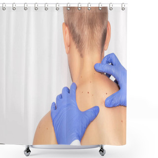 Personality  Doctor Oncologist Examines The Body Of A Male Patient For Malignant Moles, Nevus, Skin Cancer, Copy Space, Fibroma Shower Curtains