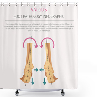 Personality  Foot Deformation As Medical Desease Infographic. Valgus And Varu Shower Curtains