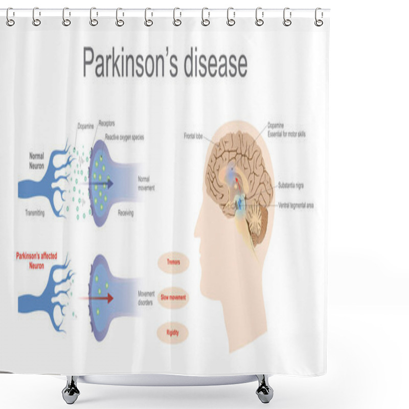 Personality  Parkinson's Disease Shower Curtains