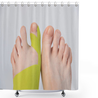 Personality  Correction Of The Big Toe. Haliux Valgus. Taping With Flat Feet. Taping When Fingers Are Deformed. Innovative Medicine. Shower Curtains