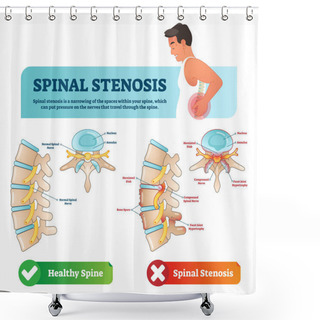 Personality  Spinal Stenosis Vector Illustration. Labeled Medical Scheme With Explanation. Diagram With Normal Spinal Nerve, Nucleus, Annulus, Bone Spurs And Compressed Spinal Nerve. Shower Curtains