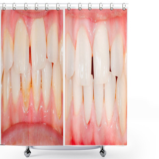 Personality  Teeth Whitening Shower Curtains