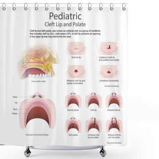 Personality  Cleft Lip And Cleft Palate. Vector Arts, Illustration. Shower Curtains