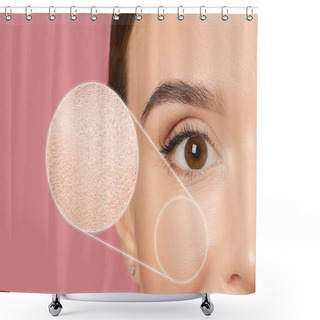 Personality  Young Woman With Dry Skin On Pink Background, Closeup Shower Curtains