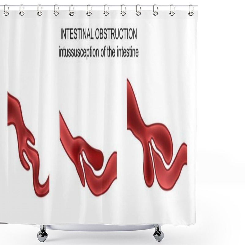 Personality  Intussusception Of The Intestine Shower Curtains