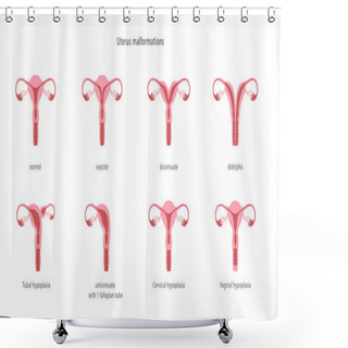Personality  Human Uterine Malformations. Set Of Medical Charts. Vector Illustration Shower Curtains