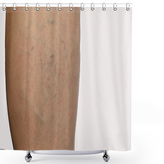 Personality   Telangiectasia And Spider Veins On The Leg Shower Curtains