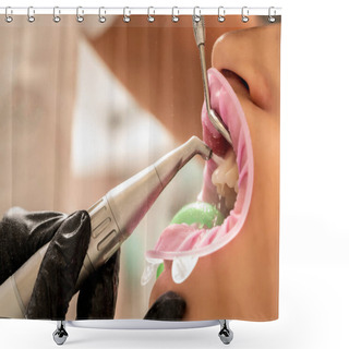 Personality  Closeup Of Teeth Sandblasting, Tartar Cleaning And Whitening Shower Curtains