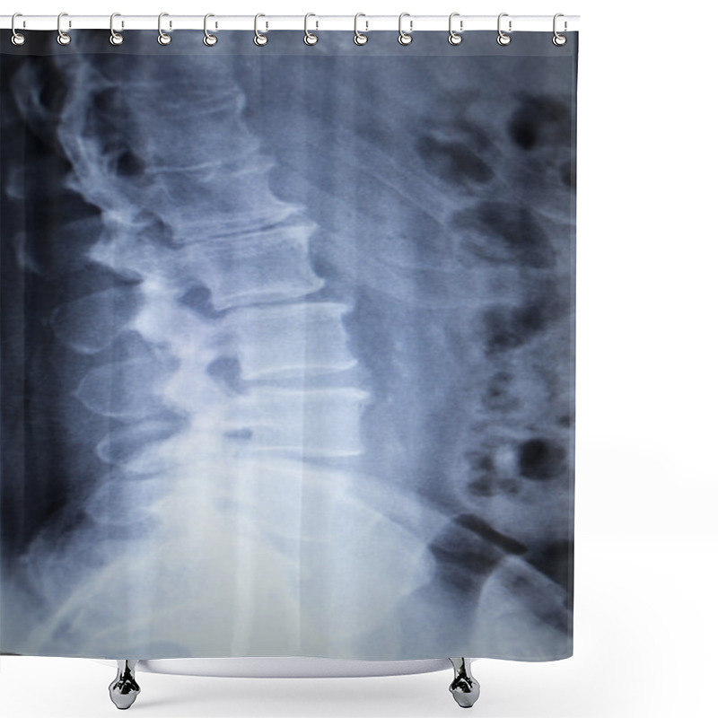 Personality  X-ray Orthopedics Traumatology Scan Back Pain Spine Injury Shower Curtains