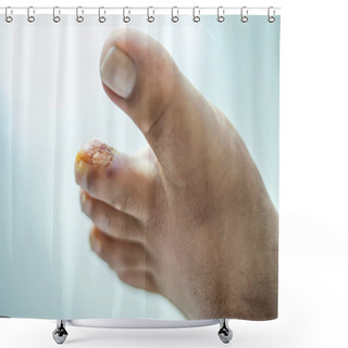 Personality  Finger On The Leg. Purulent Finger. Wound Close Up. Purulent Wound Shower Curtains