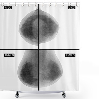 Personality  X-ray Picture Mammography. Small Calcinates. Ancer. Negative.Radiography Of Mammary Glands. Small Points Calcinates In The Upper-outer Quadrant Of The Left Mammary Gland. Shower Curtains