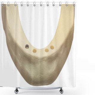 Personality  Dental Mouth Jaw Bone With Implant Shower Curtains