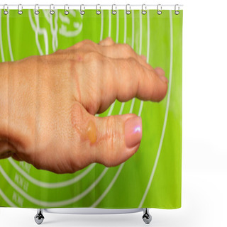 Personality  Burns Blisters From Boiling Oil On The Woman Hand Closeup Shower Curtains
