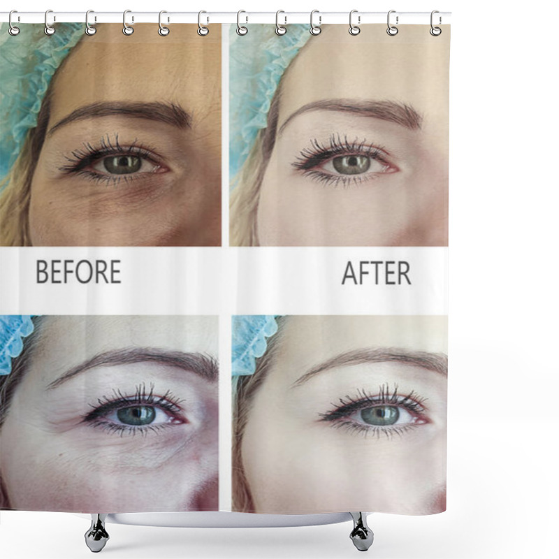 Personality  Woman Wrinkles Before And After Procedure  Shower Curtains