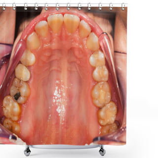 Personality  Dental Problems Shower Curtains