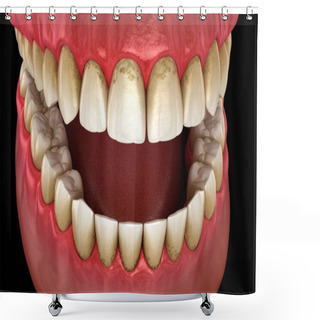 Personality  Tartar And Bactrail Tooth Plaque, Jaw Inflammation. Medically Accurate 3D Illustration Of Human Teeth Treatment Shower Curtains