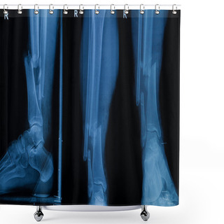 Personality  Collection Of Human X-rays  Showing Fracture Of Right Leg ( Frac Shower Curtains