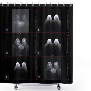 Personality  Breast Magnetic Resonance Image, Or MRI. The Bright White Dot In The Larger Images Is Stage One Breast Cancer. Shower Curtains