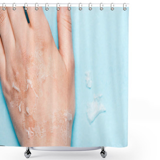 Personality  Cropped View Of Female Hand With Dead, Exfoliated Skin On Blue Shower Curtains